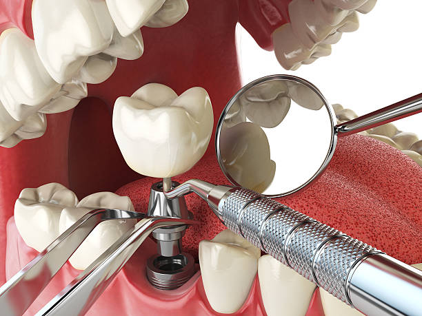 Best Root Canal Emergency Dentist  in Sterling City, TX